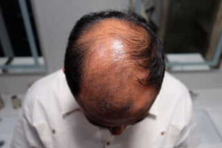 Customer Mario before using Tortoise and Hair fibers